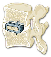Lock-Cage Implantat aus Titan-Legierung