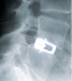 Röntgenkontrolle ca. 1 1/2 Jahre nach der OP mit zwei Lock-Cages und wiedererlangter Arbeitsfähigkeit.